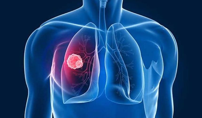 Bu belirtiler varsa dikkat! Akciğer kanseri belirtileri nelerdir?